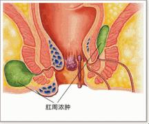 肛周脓肿示意图